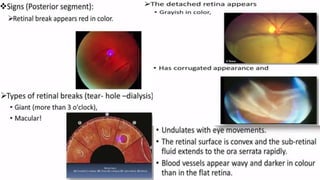 Retina retinal detachment