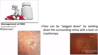 Retina retinal detachment