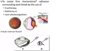 Retina retinal detachment