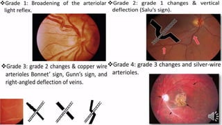 Retina vascular sclerosis