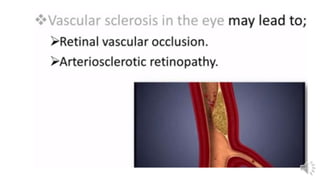 Retina vascular sclerosis