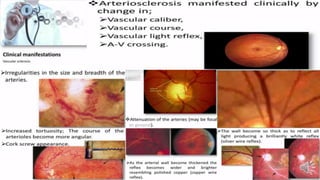 Retina vascular sclerosis