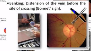 Retina vascular sclerosis