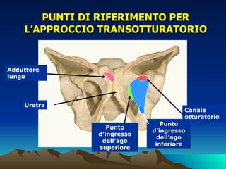 PUNTI DI RIFERIMENTO PER
    L’APPROCCIO TRANSOTTURATORIO


Adduttore
lungo




    Uretra
                                     Canale
                                     otturatorio
                               Punto
                  Punto
                            d’ingresso
               d’ingresso
                              dell’ago
                dell’ago
                             inferiore
               superiore
 