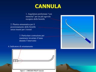 CANNULA
                    1. Angolatura preformata “con
                    memoria” per un più agevole
                    recupero delle bretelle

  2. Plastica atraumatica per il
  posizionamento delle bretelle
  senza traumi per i tessuti

             3. Particolare costruzione per
             mantenere invariato il lume
             durante l’intervento

4. Indicatore di orientamento
 