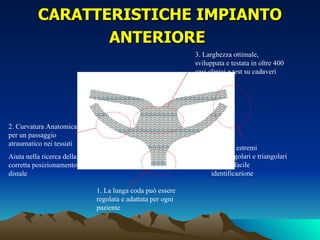 CARATTERISTICHE IMPIANTO
                 ANTERIORE
                                                           3. Larghezza ottimale,
                                                           sviluppata e testata in oltre 400
                                                           casi clinici e test su cadaveri




2. Curvatura Anatomica
per un passaggio
atraumatico nei tessuti
                                                                4. Bordi estremi
Aiuta nella ricerca della                                       quadrangolari e triangolari
corretta posizionamento                                         per una facile
distale                                                         identificazione

                            1. La lunga coda può essere
                            regolata e adattata per ogni
                            paziente
 