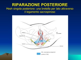 RIPARAZIONE POSTERIORE
Mesh singola posteriore: una bretella per lato attraverso
              il legamento sacrospinoso
 