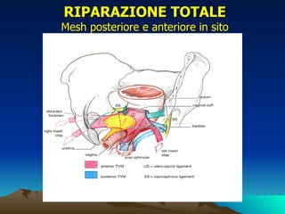 RIPARAZIONE TOTALE
Mesh posteriore e anteriore in sito
 