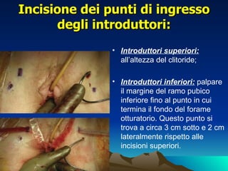 Incisione dei punti di ingresso
      degli introduttori:
               • Introduttori superiori:
                 all’altezza del clitoride;

               • Introduttori inferiori: palpare
                 il margine del ramo pubico
                 inferiore fino al punto in cui
                 termina il fondo del forame
                 otturatorio. Questo punto si
                 trova a circa 3 cm sotto e 2 cm
                 lateralmente rispetto alle
                 incisioni superiori.
 