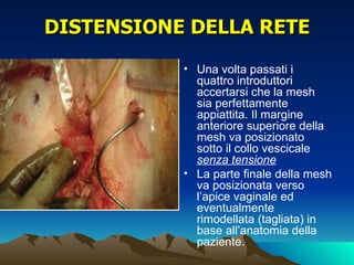 DISTENSIONE DELLA RETE
           • Una volta passati i
             quattro introduttori
             accertarsi che la mesh
             sia perfettamente
             appiattita. Il margine
             anteriore superiore della
             mesh va posizionato
             sotto il collo vescicale
             senza tensione
           • La parte finale della mesh
             va posizionata verso
             l’apice vaginale ed
             eventualmente
             rimodellata (tagliata) in
             base all’anatomia della
             paziente.
 