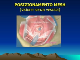 POSIZIONAMENTO MESH
  (visione senza vescica)
 