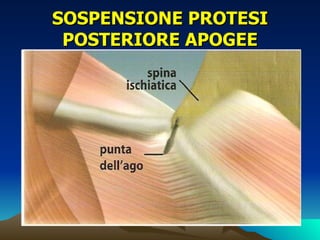 SOSPENSIONE PROTESI
 POSTERIORE APOGEE
 