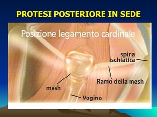 PROTESI POSTERIORE IN SEDE
 