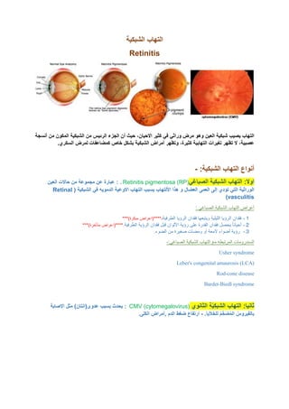 ‫الشبكية‬ ‫التهاب‬
Retinitis
‫العين‬ ‫شبكية‬ ‫يصيب‬ ‫التهاب‬
‫االحيان‬ ‫كثير‬ ‫في‬ ‫وراثي‬ ‫مرض‬ ‫وهو‬
‫أنسجة‬ ‫من‬ ‫المكون‬ ‫الشبكية‬ ‫من‬ ‫الرئيس‬ ‫الجزء‬ ‫أن‬ ‫حيث‬ ،
.‫السكري‬ ‫لمرض‬ ‫كمضاعفات‬ ‫خاص‬ ‫بشكل‬ ‫الشبكية‬ ‫أمراض‬ ‫وتظهر‬ ،‫كثيرة‬ ‫التهابية‬ ‫تغيرات‬ ‫تظهر‬ ‫ال‬ ،‫عصبية‬
:‫الشبكية‬ ‫التهاب‬ ‫أنواع‬
-
:‫اوال‬
‫الصباغي‬ ‫الشبكية‬ ‫التهاب‬
Retinitis pigmentosa (RP)
.
:
‫العين‬ ‫حاالت‬ ‫من‬ ‫مجموعة‬ ‫عن‬ ‫عبارة‬
‫الور‬
‫العضال‬ ‫العمى‬ ‫إلى‬ ‫تؤدي‬ ‫التي‬ ‫اثية‬
‫الشبكية‬ ‫في‬ ‫الدمويه‬ ‫االوعية‬ ‫التهاب‬ ‫يسبب‬ ‫األلتهاب‬ ‫هذا‬ ‫و‬
(
Retinal
vasculitis
)
: ‫الصباغي‬ ‫الشبكية‬ ‫التهاب‬ ‫أعراض‬
１
-
‫ويتبعها‬ ‫الليلية‬ ‫الرؤيا‬ ‫فقدان‬
‫الطرفية‬ ‫الرؤيا‬ ‫فقدان‬
،
***)‫مبكرة‬ ‫****(اعراض‬
２
-
‫الطرفية‬ ‫الرؤية‬ ‫فقدان‬ ‫قبل‬ ‫األلوان‬ ‫رؤية‬ ‫على‬ ‫القدرة‬ ‫فقدان‬ ‫يحصل‬ ً‫ا‬‫أحيان‬
.
***)‫متأخرة‬ ‫****(اعراض‬
３
-
.‫الضوء‬ ‫من‬ ‫صغيرة‬ ‫ومضات‬ ‫أو‬ ‫المعة‬ ‫أضواء‬ ‫رؤية‬
:‫الصباغي‬ ‫الشبكية‬ ‫التهاب‬ ‫مع‬ ‫المرتبطه‬ ‫السندرومات‬
-
Usher syndrome
congenital amaurosis (LCA)
Leber's
cone disease
-
Rod
Biedl syndrome
-
Bardet
:‫ثانيا‬
ِ‫ة‬ّ‫ي‬ِ‫ك‬‫الشب‬ ‫التهاب‬
‫الثانوي‬
CMV (cytomegalovirus)
:
‫االصابة‬ ‫مثل‬ )‫عدوى(انتان‬ ‫بسبب‬ ‫يحدث‬
.‫يا‬َ‫ال‬َ‫خ‬‫لل‬ ُ‫م‬ِّ‫َخ‬‫ض‬ُ‫م‬‫ال‬ ُ‫يروس‬َ‫ف‬‫بال‬
-
.‫الكلى‬ ‫أمراض‬, ‫الدم‬ ‫ضغط‬ ‫ارتفاع‬
 