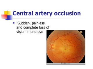 Central artery occlusion ·Sudden, painless and complete loss of vision in one eye  