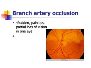 Branch artery occlusion ·Sudden, painless, partial loss of vision in one eye     