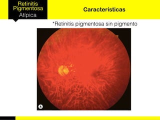 Retinitis
Pigmentosa
Atípica
Características
*Retinitis pigmentosa sin pigmento
 