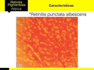 Retinitis
Pigmentosa
Atípica
Características
*Retinitis punctata albescens
 