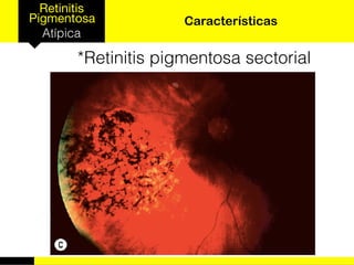 Retinitis
Pigmentosa
Atípica
Características
*Retinitis pigmentosa sectorial
 