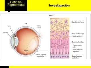 Retinitis
Pigmentosa Investigación
 