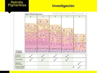 Retinitis
Pigmentosa Investigación
 