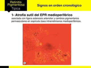 Retinitis
Pigmentosa
Típica
Signos en orden cronológico
1- Atroﬁa sutil del EPR medioperiférico
asociada con ligera estenosis arteriolar y cambios pigmentarios
perivasculares en espícula ósea intrarretinianos medioperiféricos.
 