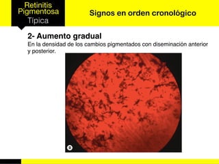Retinitis
Pigmentosa
Típica
Signos en orden cronológico
2- Aumento gradual
En la densidad de los cambios pigmentados con diseminación anterior
y posterior.
 