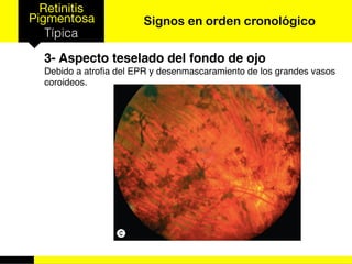 Retinitis
Pigmentosa
Típica
Signos en orden cronológico
3- Aspecto teselado del fondo de ojo
Debido a atroﬁa del EPR y desenmascaramiento de los grandes vasos
coroideos.
 