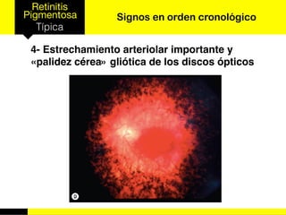 Retinitis
Pigmentosa
Típica
Signos en orden cronológico
4- Estrechamiento arteriolar importante y
«palidez cérea» gliótica de los discos ópticos
 