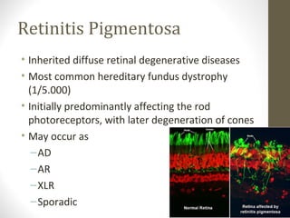 Retinitis Pigmentosa
• Inherited diffuse retinal degenerative diseases
• Most common hereditary fundus dystrophy
(1/5.000)
• Initially predominantly affecting the rod
photoreceptors, with later degeneration of cones
• May occur as
–AD
–AR
–XLR
–Sporadic
 
