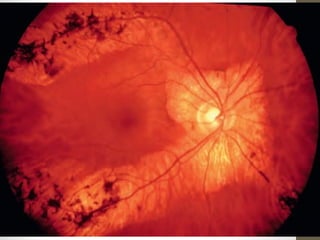 Retinitis pigmentosa