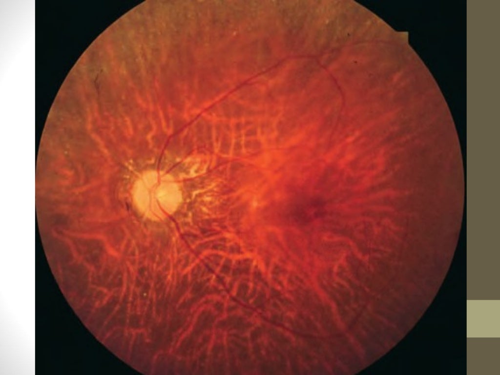Retinitis pigmentosa