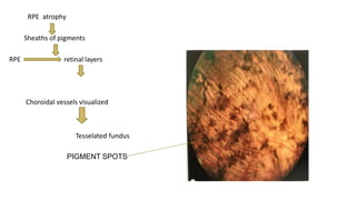 Progressive Atrophy Rpe Retinitis pigmentosa and allied disorders | PPTX