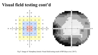 Visual field testing cont’d
Fig 5: Image of Humphrey kinetic Visual field testing result of RP (Sayo et al. 2017).
 
