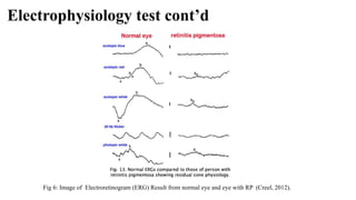 Electrophysiology test cont’d
Fig 6: Image of Electroretinogram (ERG) Result from normal eye and eye with RP (Creel, 2012).
 