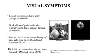 VISUAL SYMPTOMS
• Loss of night vision due to early
damage of rod cells
• Gradual loss of peripheral vision
(tunnel vision) due to gradual damage
of rod cells.
• Loss of central vision due to damage of
cone cells (late stage) (Kamde and
Anjankar, 2023).
N.B: RP can start unilaterally and move
bilaterally (Moini & Piran, 2020).
Fig 2: Image of normal vision and tunnel vision in RP
(Mandal, 2023).
 