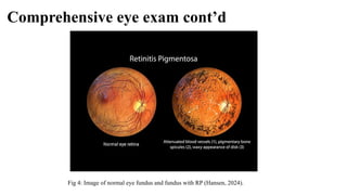 Comprehensive eye exam cont’d
Fig 4: Image of normal eye fundus and fundus with RP (Hansen, 2024).
 