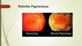 Retinitis Pigmentosa
 