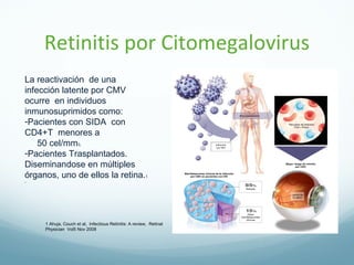 Retinitis por citomegalovirus | PPT