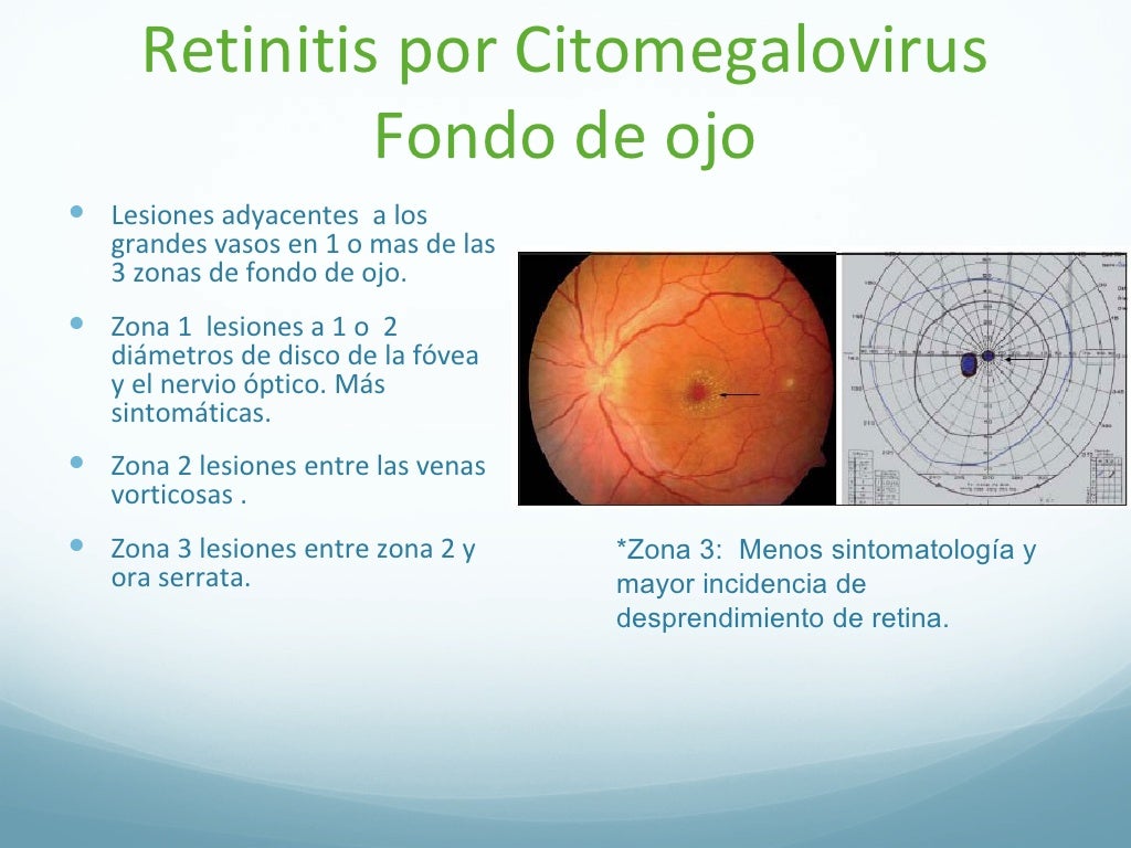 Retinitis por citomegalovirus