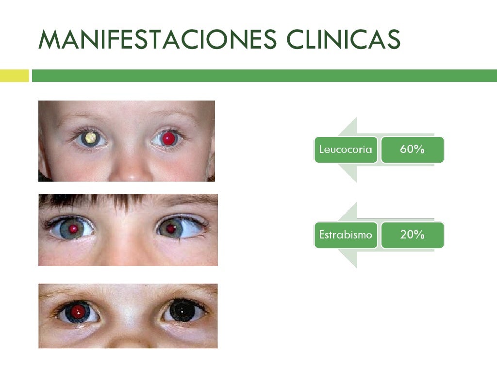 Retinoblastoma