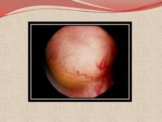 Clasificación de RetinoblastomaUna clasificación sistemática e  ideal para el retinoblastoma debe incluir dos componentes: la agrupación (es un sistema de clínicas de pronosticando de rescate de órganos)