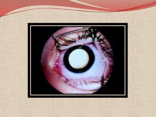 El diagnóstico de RetinoblastomaUna evaluación clínica completa con la atención cuidadosa a los detalles, con la ayuda de la ultrasonografía B-scan ayuda en la diagnosis. La tomografía computarizada y la resonancia magnética son generalmente reservada para los casos con manifestaciones atípicas y el dilema de diagnóstico y en caso de sospecha de extensión del tumor extraocular o intracraneal. 