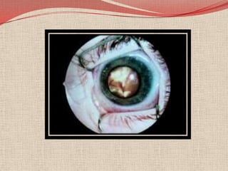 Un niño con sospecha de retinoblastoma necesariamente necesita una evaluación oftalmológica completa, incluyendo un examen del fondo de ojo dilatado en anaesthesia.