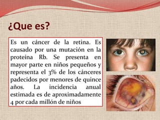 ¿Que es?Es un cáncer de la retina. Es causado por una mutación en la proteína Rb. Se presenta en mayor parte en niños pequeños y representa el 3% de los cánceres padecidos por menores de quince años. La incidencia anual estimada es de aproximadamente 4 por cada millón de niños  