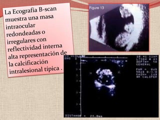 Riesgo de la futura descendencia de desarrollar retinoblastoma cuando existe un historial familiar negativo (y con una penetrancia del 80%)