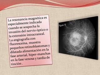 En aquellas situaciones en que no exista un estudio genético previo el diagnóstico prenatal se realizará haciendo las siguientes consideraciones:a) En aquellos casos hereditarios con dos miembrosafectos como mínimo, se puede realizar unanálisis de ligamiento utilizando marcadorespolimórficos, para ver si en el feto el marcadorde ADN informativo segrega con el alelo normalo con el alelo mutado y así descartar con seguridadque el feto pueda estar afecto.