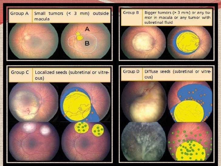 Retinoblastoma