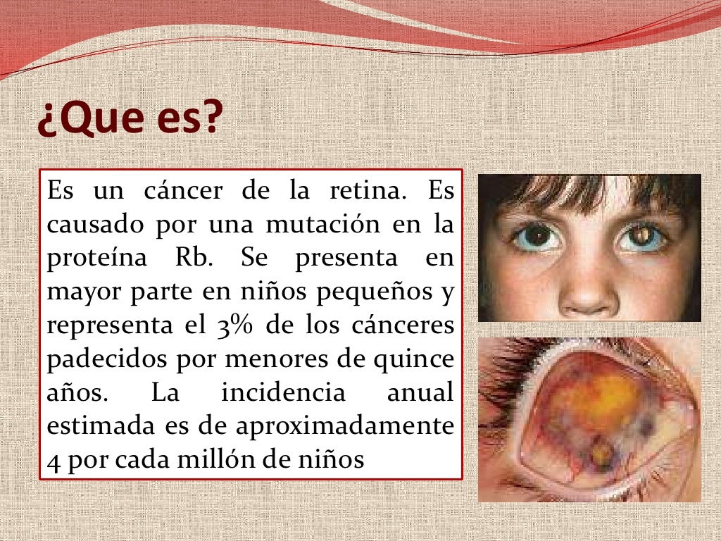 ¿Que es?<br />Es un cáncer de la retina. Es causado por una mutación en la proteína Rb. Se presenta en mayor parte en niño...