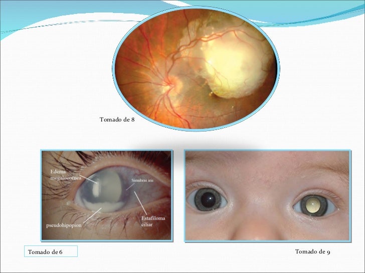 Retinoblastoma
